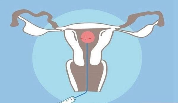 腺肌症对胚胎移植和着床的直接影响