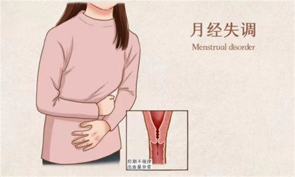 月经不规律会导致不孕不育吗?