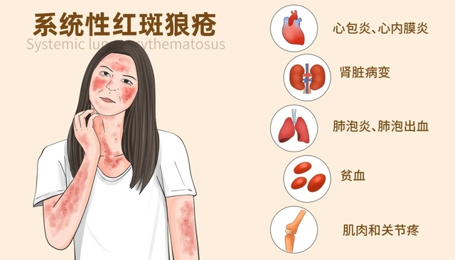 红斑狼疮：美丽背后的杀手，竟会影响胚胎