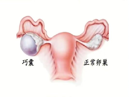 巧囊会影响吉尔吉斯斯坦试管促排吗?